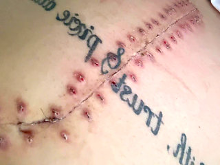 Scar Fetishes Stitches Staples Hospital Recovery After Surgery Teen Petite Small Waist