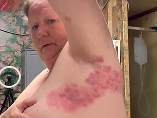 Bad Case of Shingles