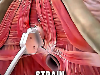 V Tone Procedure Explained