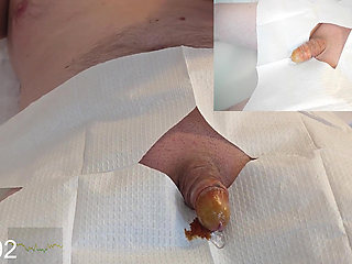 Close-Up insertion of a 16 French foley catheter