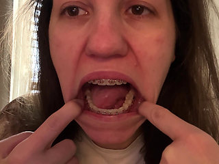 Licking Your Braces with Your Tongue