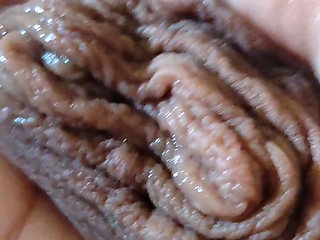 Immense Phimosis Being Extracted Cum and Prcum.