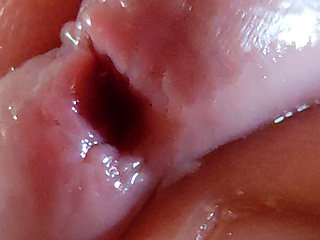 Dilation of the Glans Eye Has a Pleasant Surprise.