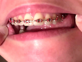 Licking Your Braces with Your Tongue