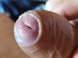 Deep Split in the Glans Produces Bubbling Liquid